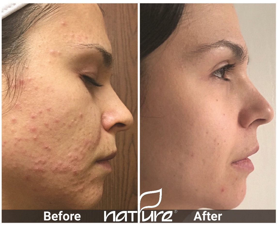 Holistic Clinical Acne Treatment Protocol