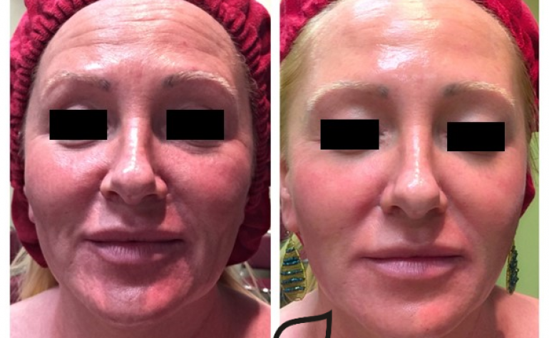 Dissolve Wrinkles & Reverse Menopausal Skin Changes Treatment
